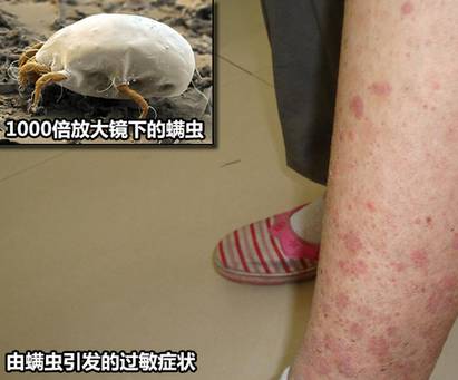 螨虫会引发多种皮肤过敏症状